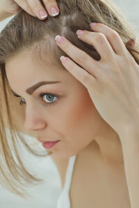 Alopecia Androgenetica Femminile 2